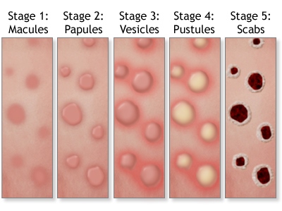 Understanding Mpox: Symptoms, Prevention, and Treatment – Guardian ...